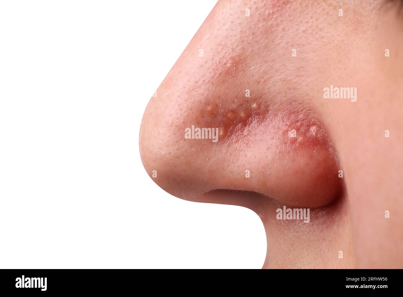 Jeune femme avec problème d'acné sur fond gris, gros plan Banque D'Images