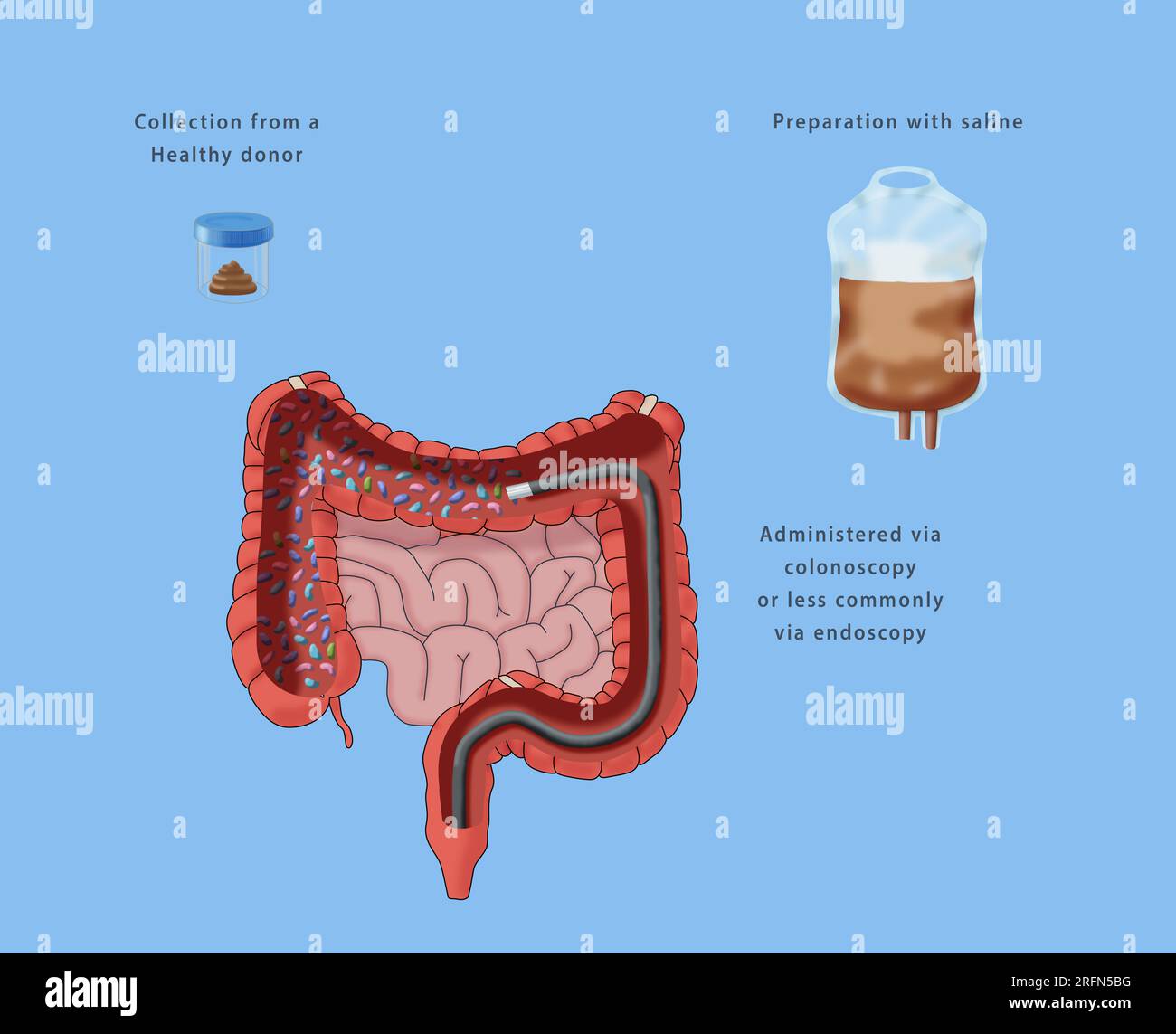 Une illustration des composants de la transplantation de microbiote ...