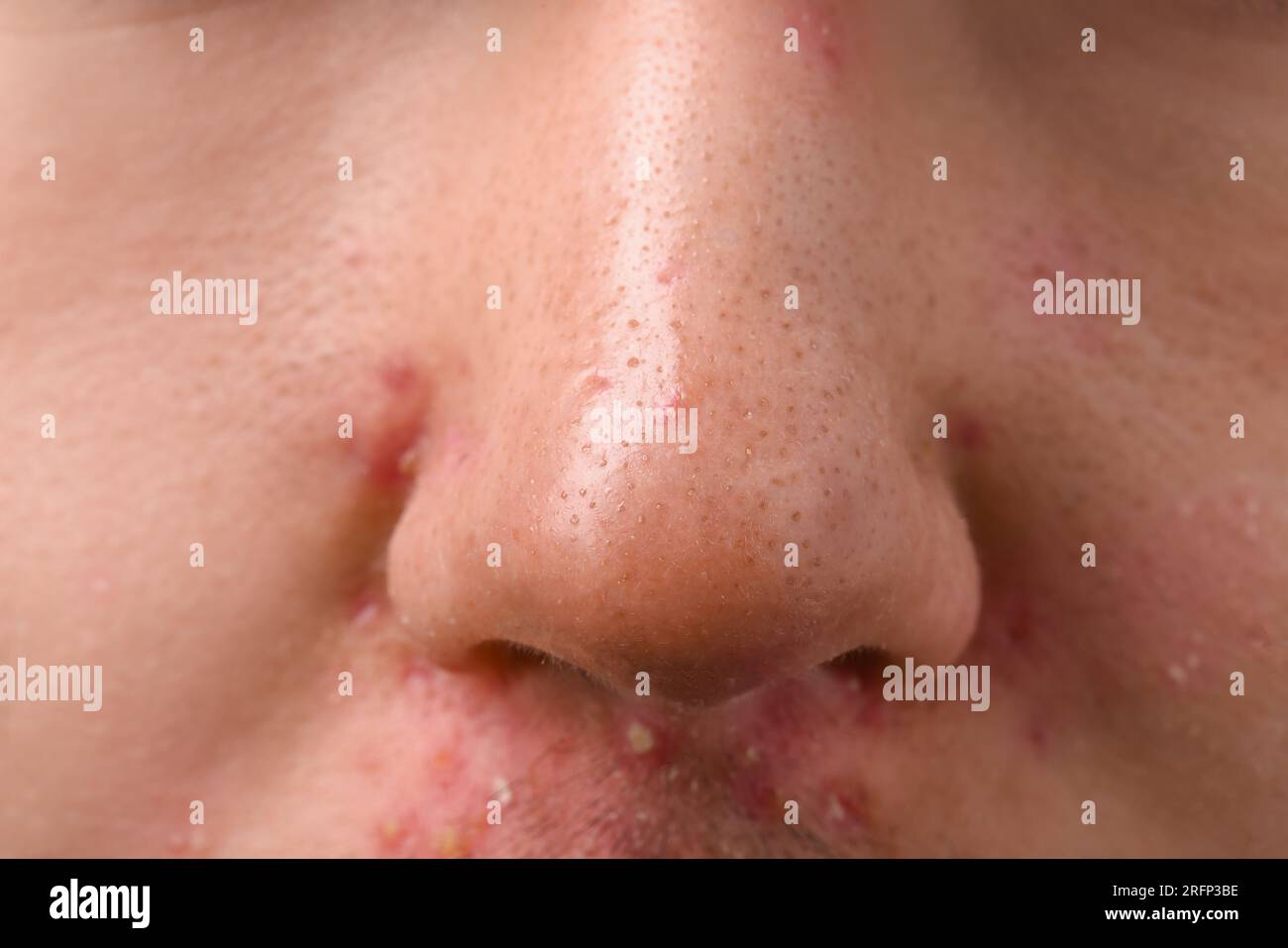 Jeune homme avec problème d'acné, vue rapprochée du nez Banque D'Images