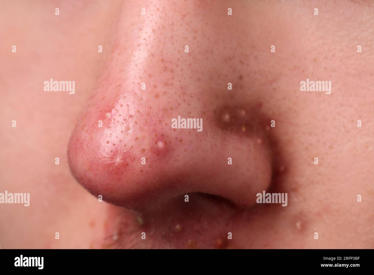 Jeune homme avec problème d'acné, vue rapprochée du nez Banque D'Images