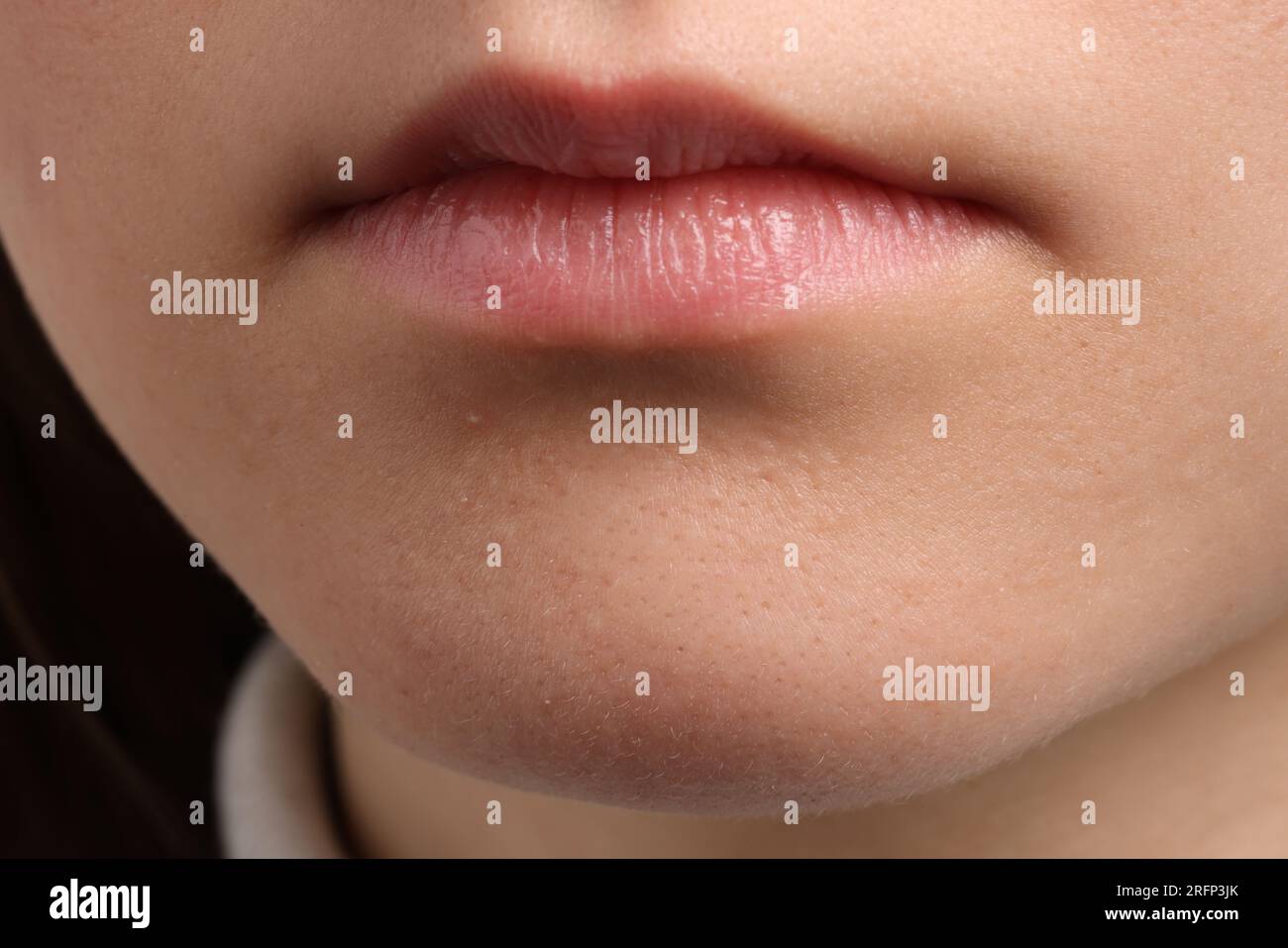 Jeune femme avec problème d'acné, vue rapprochée Banque D'Images