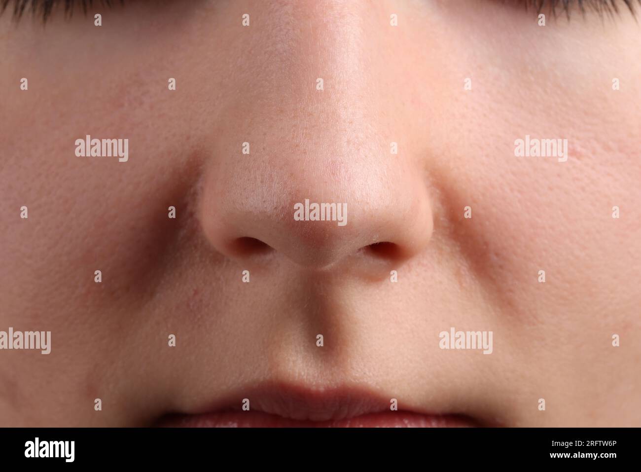 Jeune femme avec problème d'acné, vue rapprochée Banque D'Images