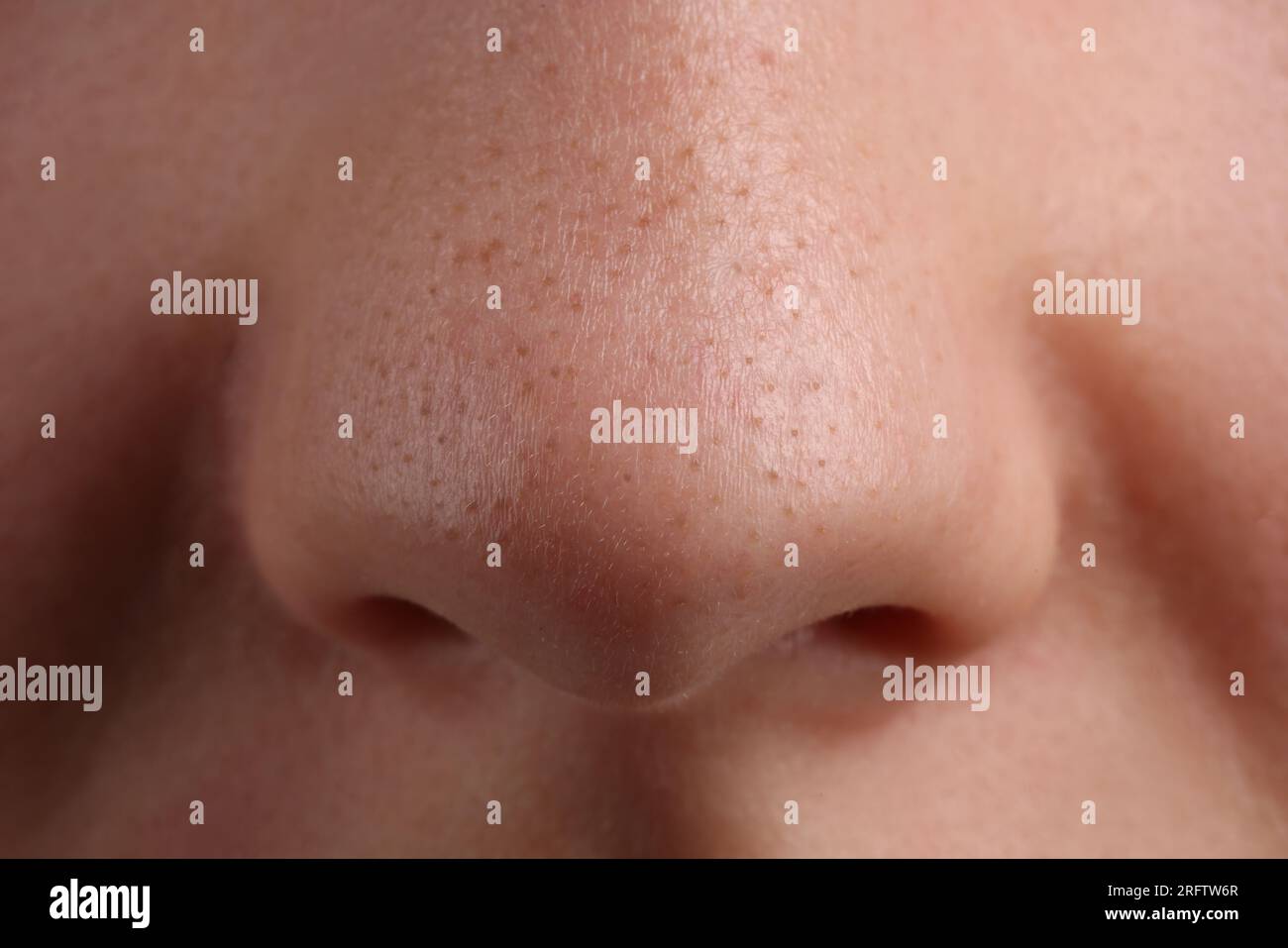 Jeune femme avec problème d'acné, vue rapprochée du nez Banque D'Images