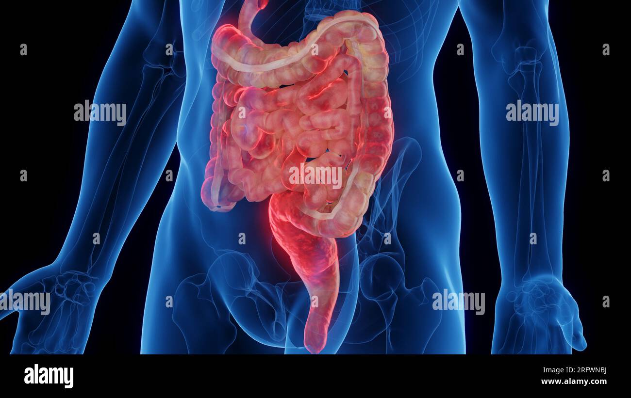 Intestins atteints de maladie de Crohn, illustration Banque D'Images