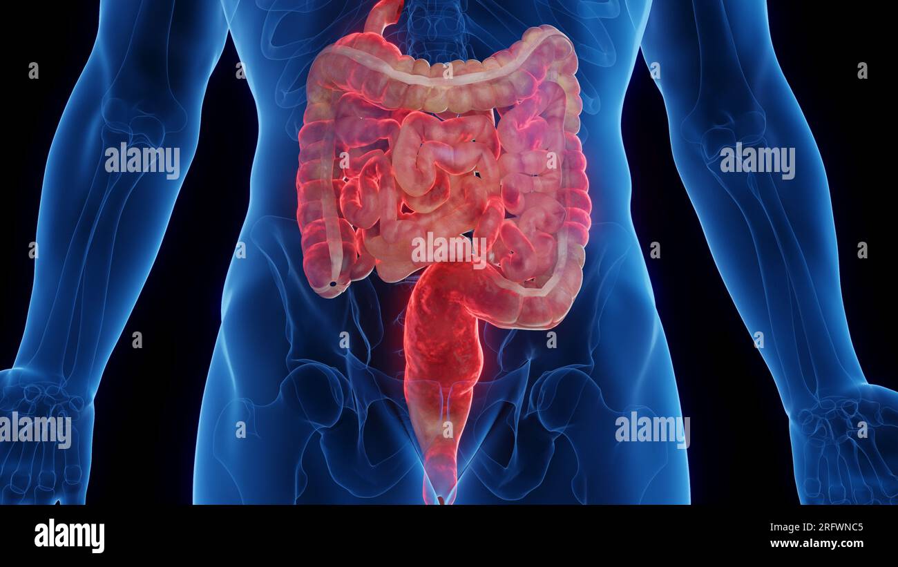 Intestins atteints de maladie de Crohn, illustration Banque D'Images