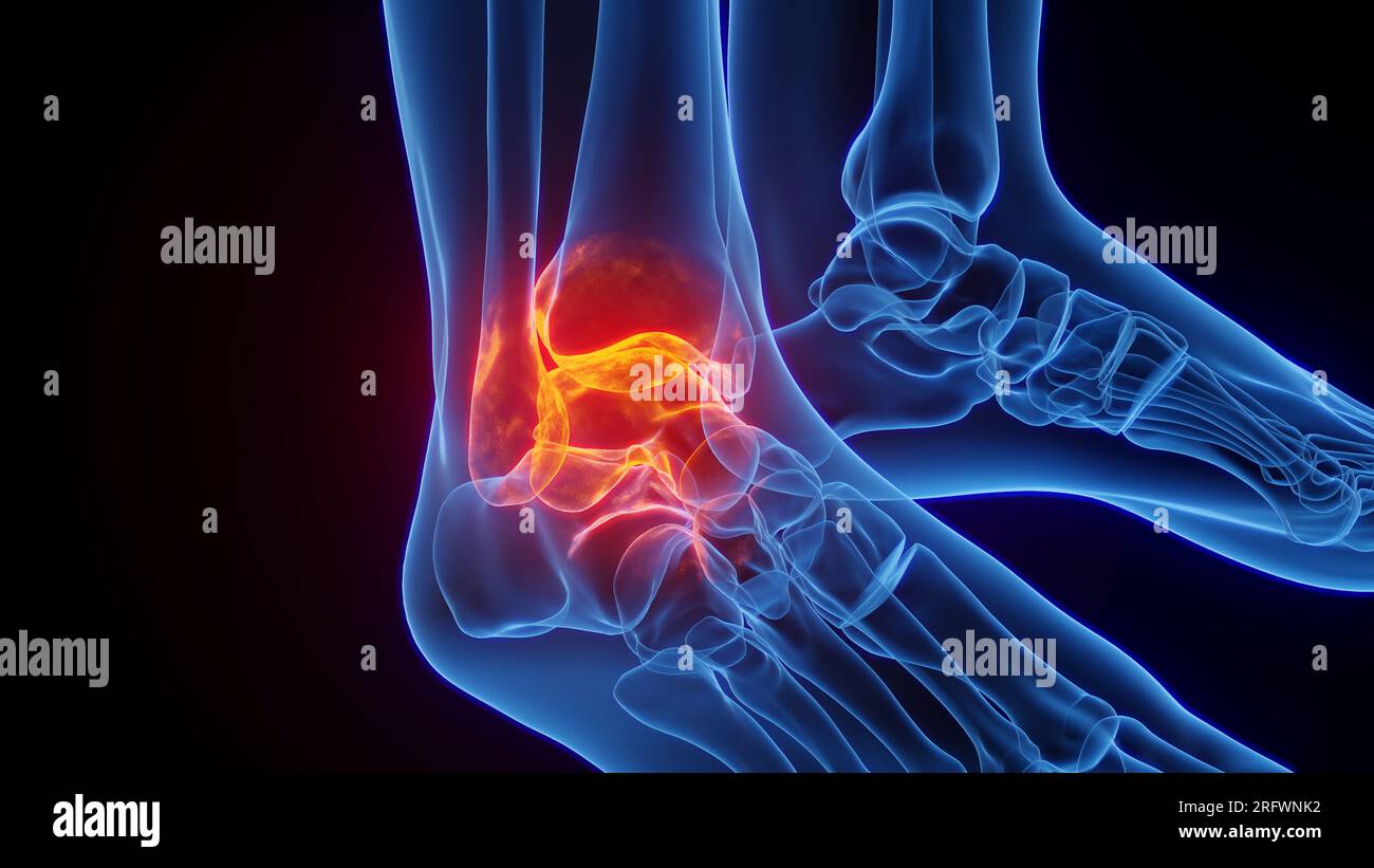 Cheville enflammée, illustration Banque D'Images