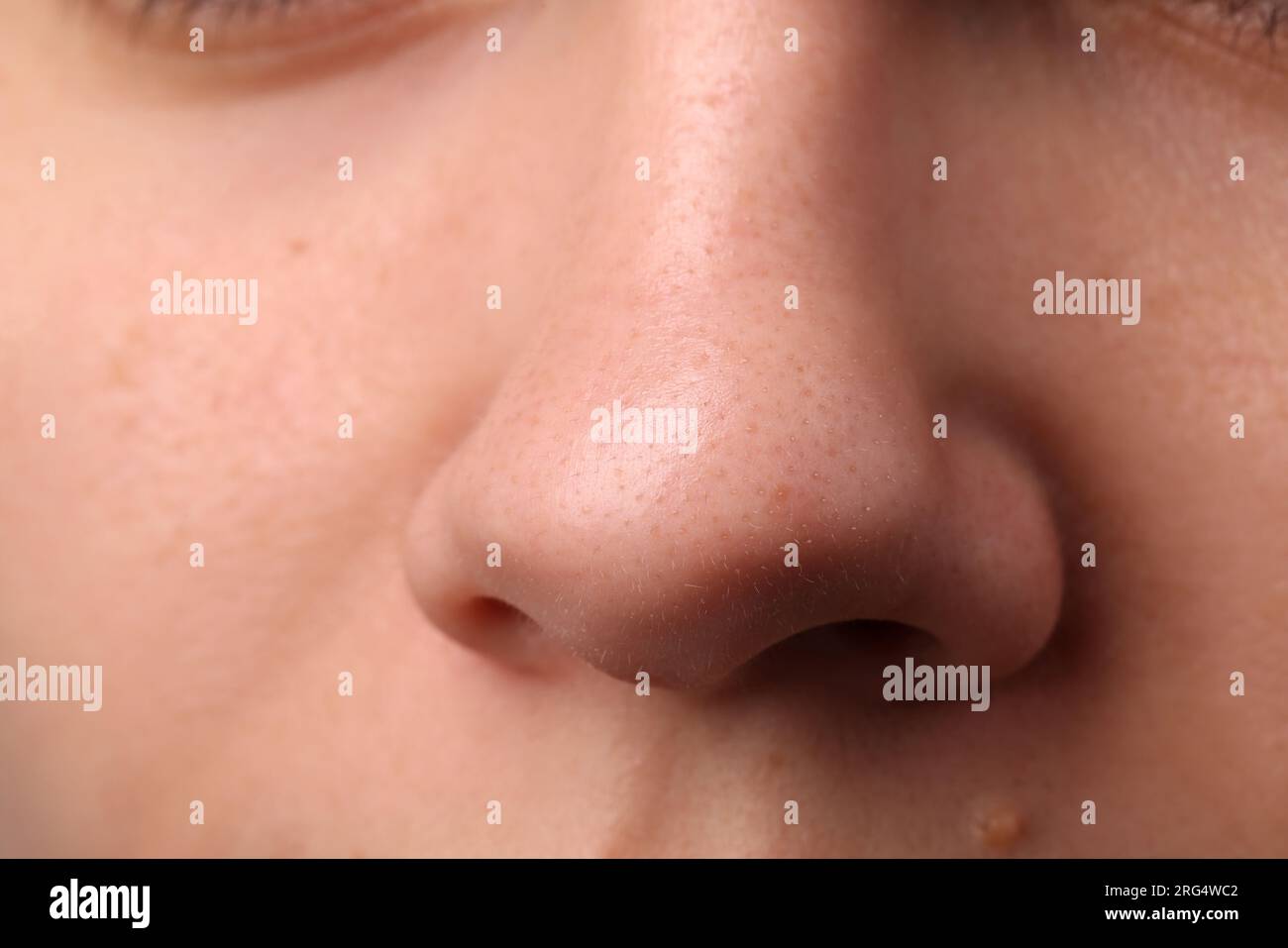 Jeune femme avec problème d'acné, vue rapprochée du nez Banque D'Images