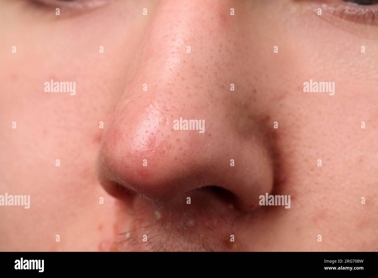 Jeune homme avec problème d'acné, vue rapprochée du nez Banque D'Images