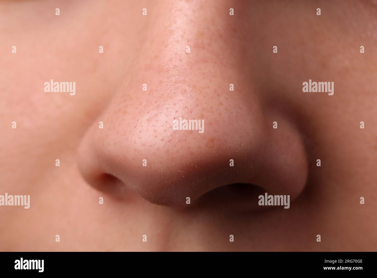 Jeune femme avec problème d'acné, vue rapprochée du nez Banque D'Images