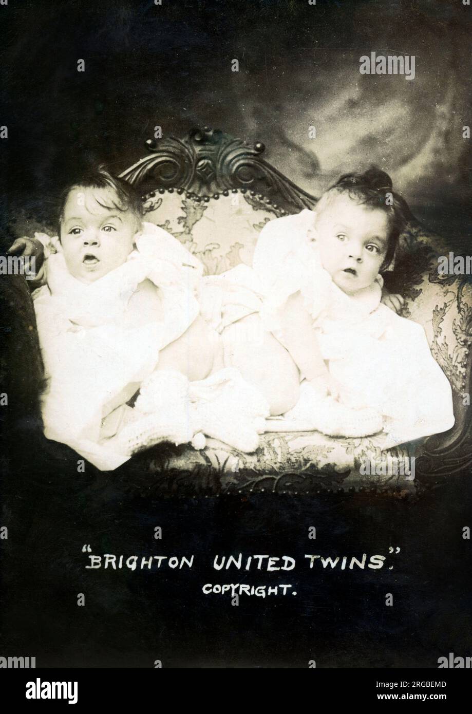 Les 'Brighton United Twins' - célèbres sœurs conjointes Daisy et Violet Hilton (1908-1969). Les jumeaux ont été exposés en Europe quand ils étaient enfants, et ont visité les circuits Sidehow, vaudeville et burlesque américains dans les années 1920 et 1930 Ils sont surtout connus pour leurs apparitions au cinéma dans Freaks et The Biographic Chained for Life (1951). Banque D'Images