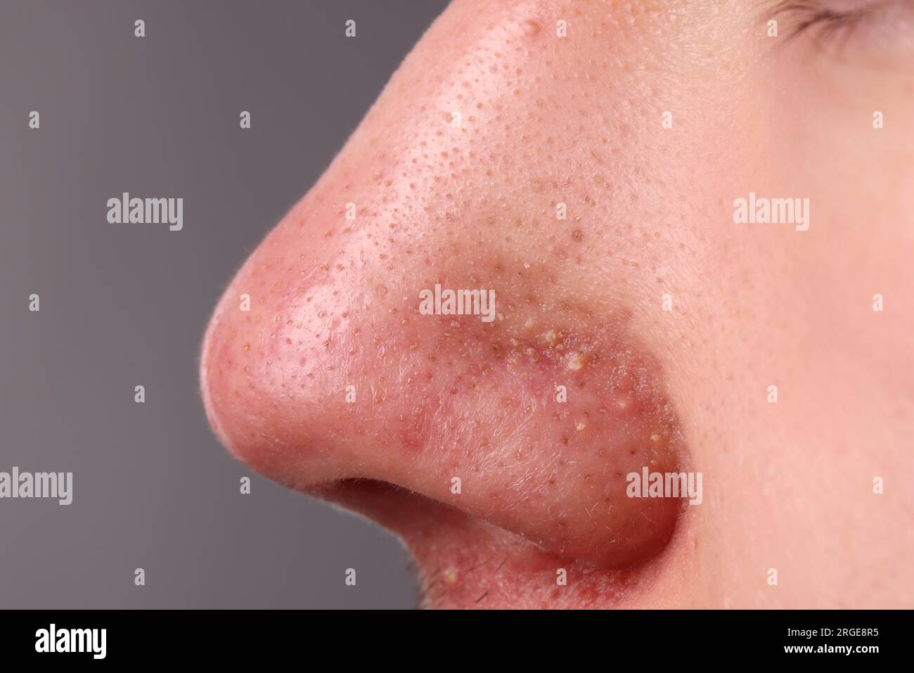 Jeune homme avec problème d'acné sur fond gris, vue rapprochée du nez Banque D'Images