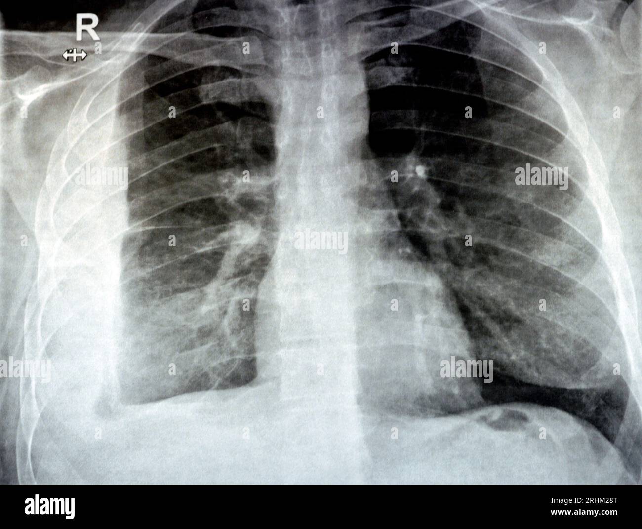 Radiographie simple pour un patient atteint d'une pneumonie par aspiration du poumon droit, d'un empyème, d'un épanchement pleural après insertion d'un tube de thoracostomie thoracique pour drainer l'up Banque D'Images