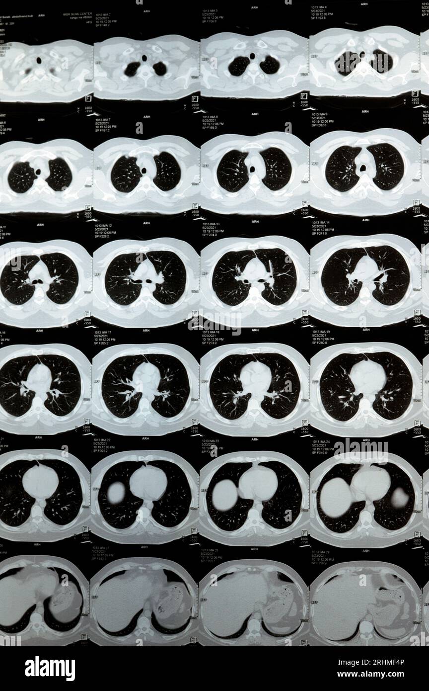 TDM multi-coupes du thorax montrant une étude normale, un aspect normal des poumons, un parenchyme, une vascularisation pulmonaire, des structures médiastinales, non Banque D'Images