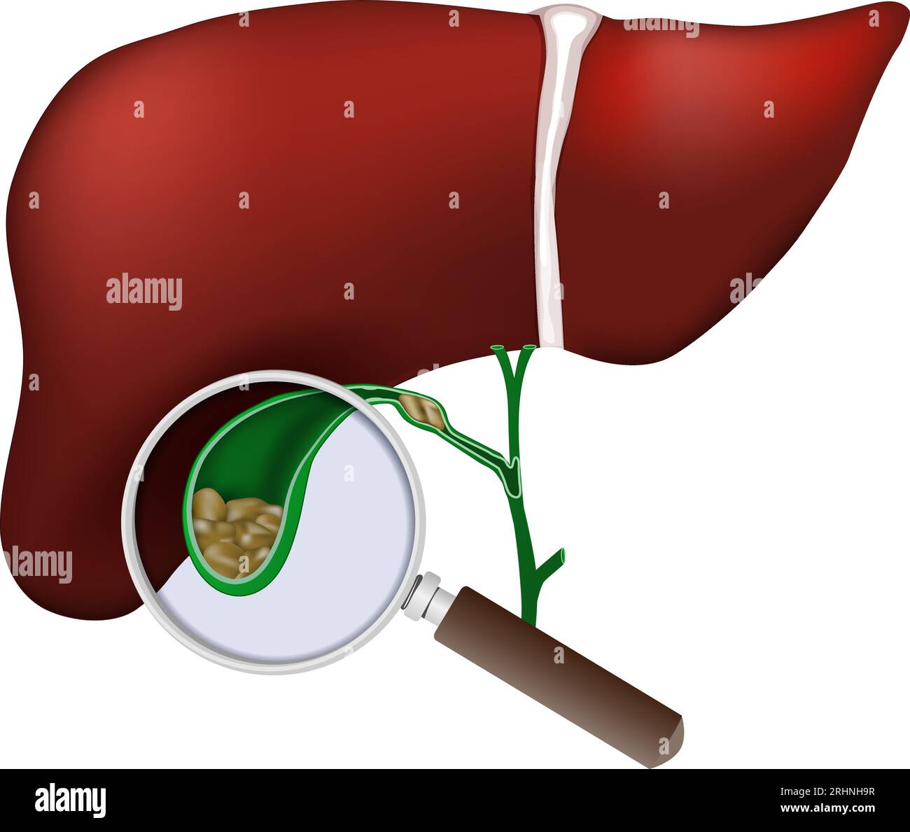 Foie humain. Gros plan de la vésicule biliaire. la loupe examine les calculs biliaires dans la vésicule biliaire. Problèmes de dyskinésie biliaire, Cholecystite laboratoire res Illustration de Vecteur