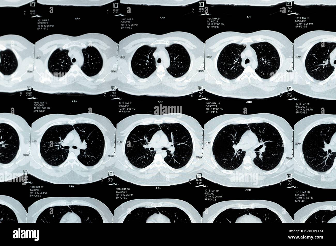 TDM multi-coupes du thorax montrant une étude normale, un aspect normal des poumons, un parenchyme, une vascularisation pulmonaire, des structures médiastinales, non Banque D'Images