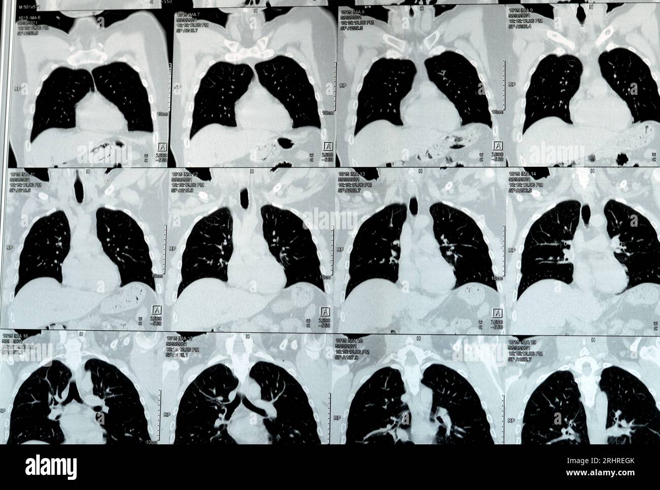 TDM multi-coupes du thorax montrant une étude normale, un aspect normal des poumons, un parenchyme, une vascularisation pulmonaire, des structures médiastinales, non Banque D'Images