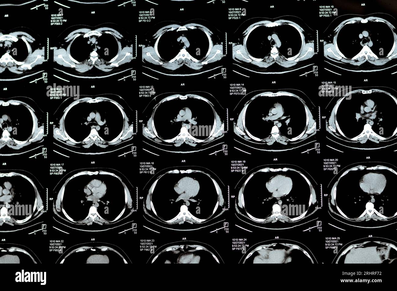 TDM multi-coupes du thorax montrant une étude normale, un aspect normal des poumons, un parenchyme, une vascularisation pulmonaire, des structures médiastinales, non Banque D'Images