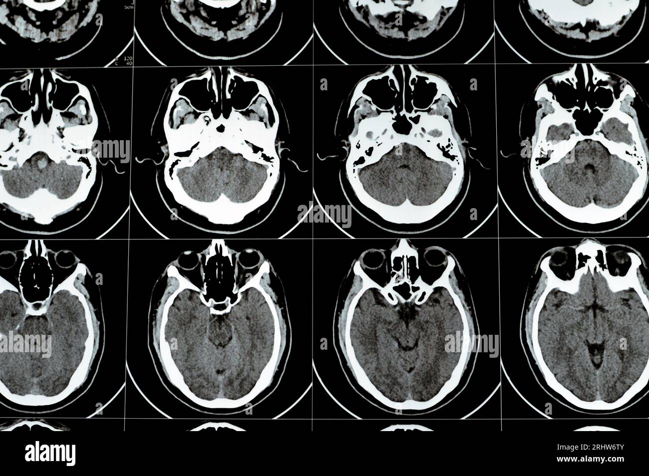 TDM multi-coupes du cerveau montrant un gros tronc cérébral et un hématome sémioval au centre droit, des structures de fosse postérieure normales, une taille normale du vent Banque D'Images