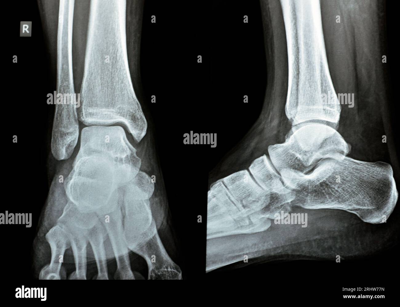 Radiographie directe AP vues latérales de la cheville droite montrant une entorse syndesmotique de la cheville, une blessure à un ou plusieurs ligaments comprenant le tibiofib distal Banque D'Images