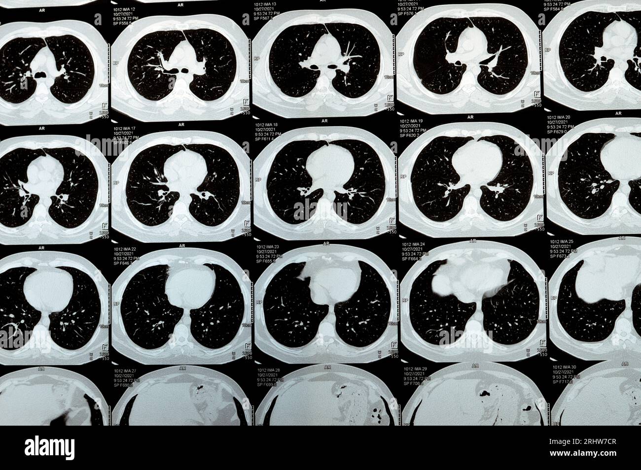 TDM multi-coupes du thorax montrant une étude normale, un aspect normal des poumons, un parenchyme, une vascularisation pulmonaire, des structures médiastinales, non Banque D'Images