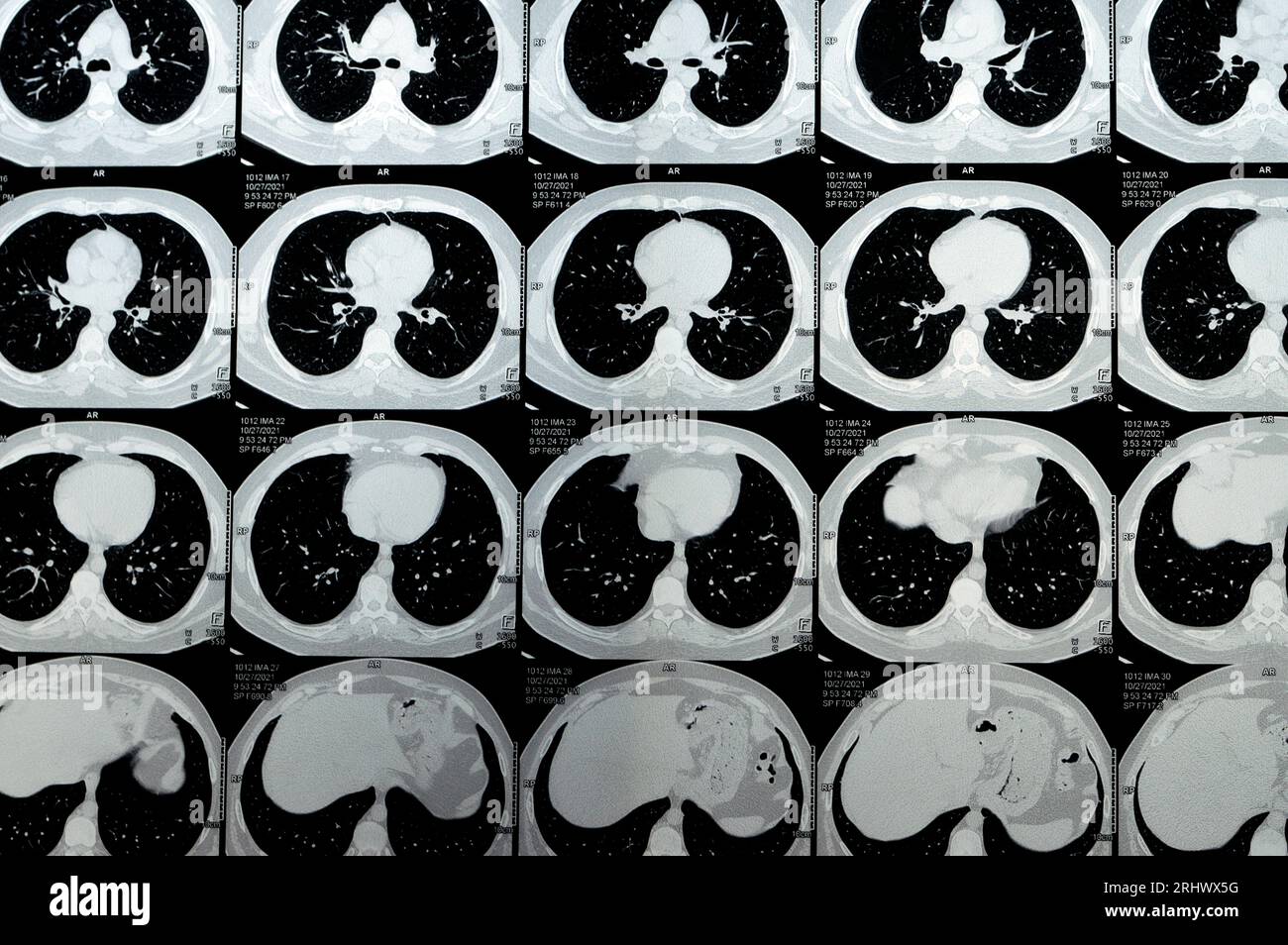TDM multi-coupes du thorax montrant une étude normale, un aspect normal des poumons, un parenchyme, une vascularisation pulmonaire, des structures médiastinales, non Banque D'Images