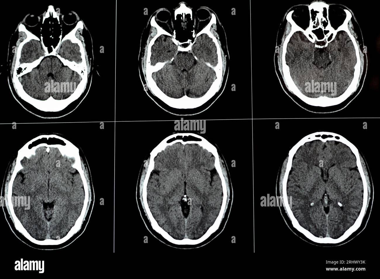 TDM cérébrale montrant un cavernome du tronc cérébral, une anomalie veineuse développementale du centre sémiovale droit, un hématome intra-cérébral, une légère lésion hypodense en M. Banque D'Images