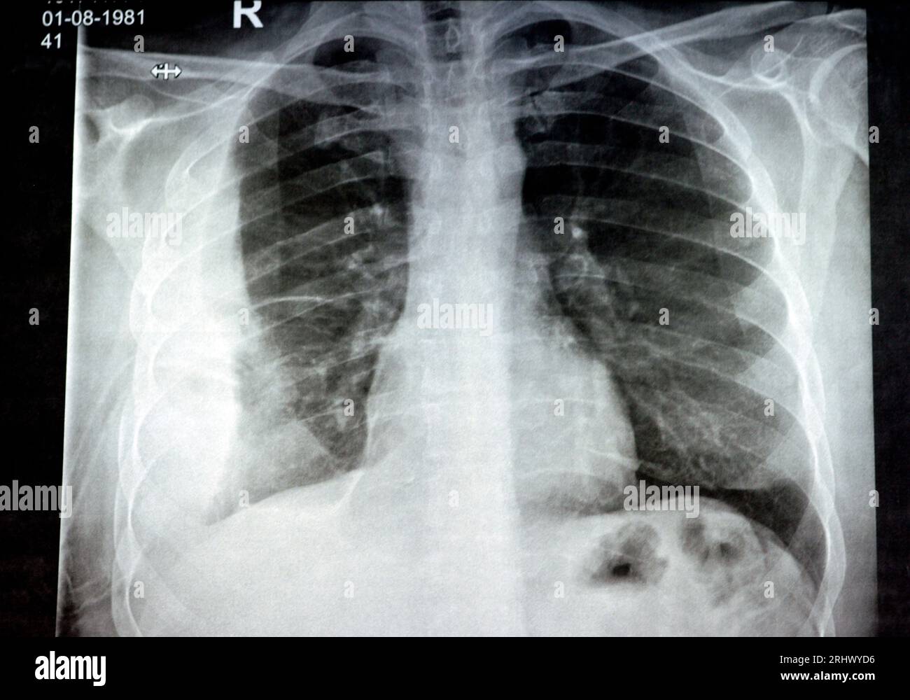 Radiographie simple pour un patient atteint d'une pneumonie par aspiration du poumon droit, d'un empyème, d'un épanchement pleural après insertion d'un tube de thoracostomie thoracique pour drainer l'up Banque D'Images