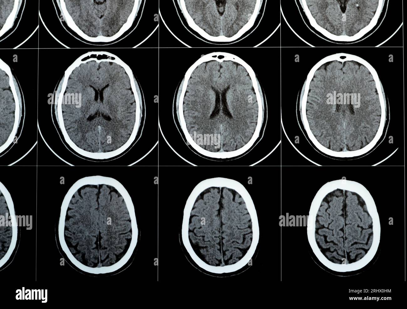 TDM multi-coupes du cerveau montrant un gros tronc cérébral et un hématome sémioval au centre droit, des structures de fosse postérieure normales, une taille normale du vent Banque D'Images