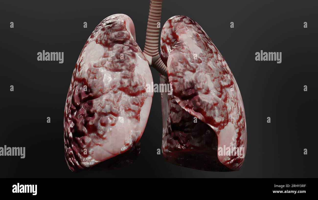 Pneumonie maladie, poumons sains et maladies poumons, cancer des poumons humains, fumeurs de cigarettes maladie pulmonaire, tumeur maligne cancéreuse en croissance et propagation Banque D'Images