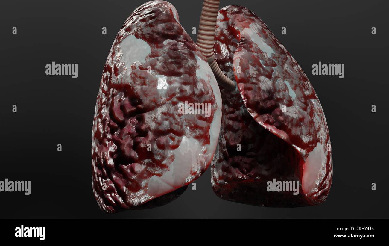 Pneumonie maladie, poumons sains et maladies poumons, cancer des poumons humains, fumeurs de cigarettes maladie pulmonaire, tumeur maligne cancéreuse en croissance et propagation Banque D'Images