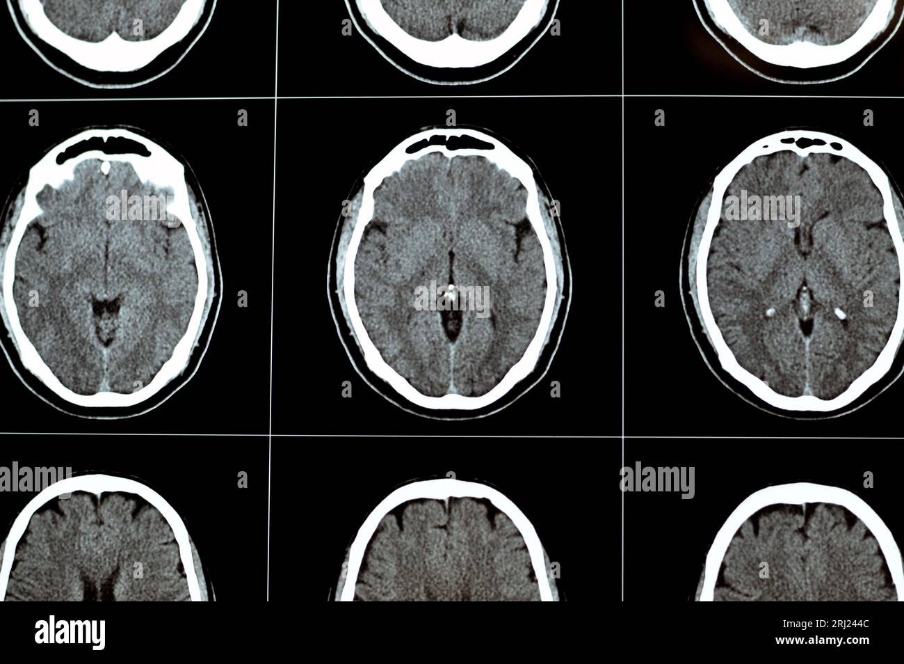TDM cérébrale montrant un cavernome du tronc cérébral, une anomalie veineuse développementale du centre sémiovale droit, un hématome intra-cérébral, une légère lésion hypodense en M. Banque D'Images
