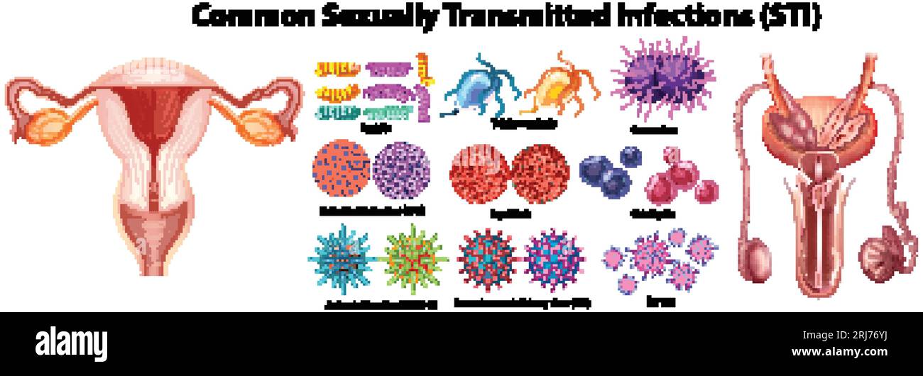 Infographie illustrée mettant en évidence les infections sexuellement transmissibles courantes chez les hommes et les femmes Illustration de Vecteur