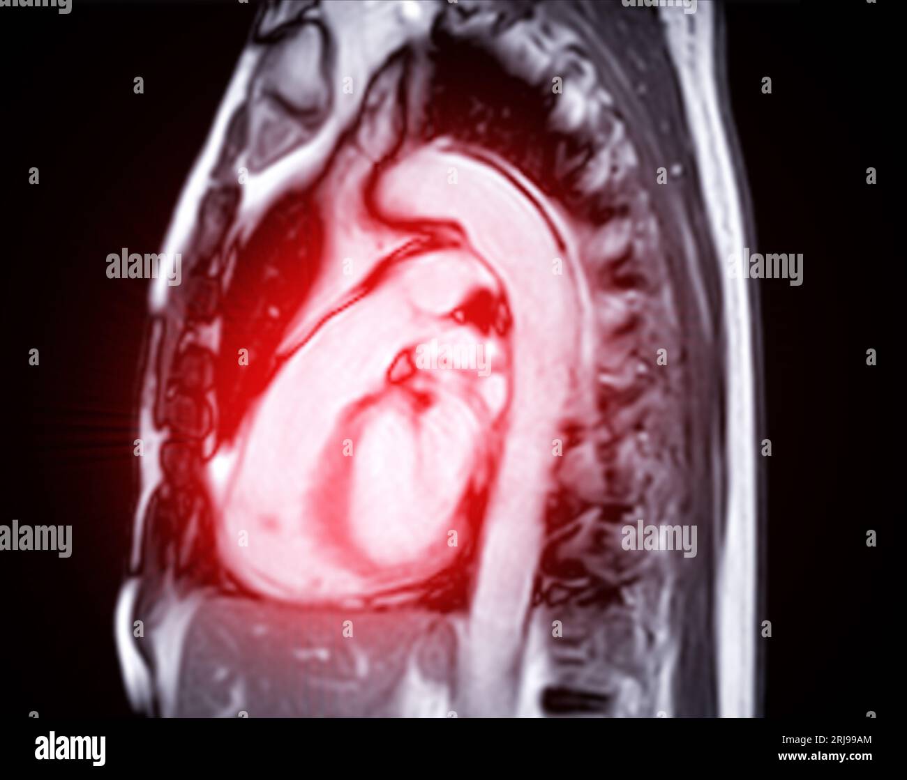 IRM cardiaque ou IRM cardiaque ( imagerie par résonance magnétique ) du coeur pour le diagnostic des maladies cardiaques. Banque D'Images