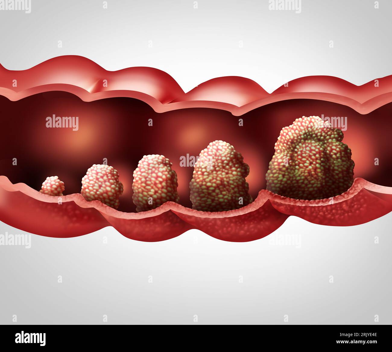 Stades du cancer Prognose et progression tumorale métastase Colon ou cancer colorectal concept comme illustration médicale avec une croissance tumorale maligne Banque D'Images