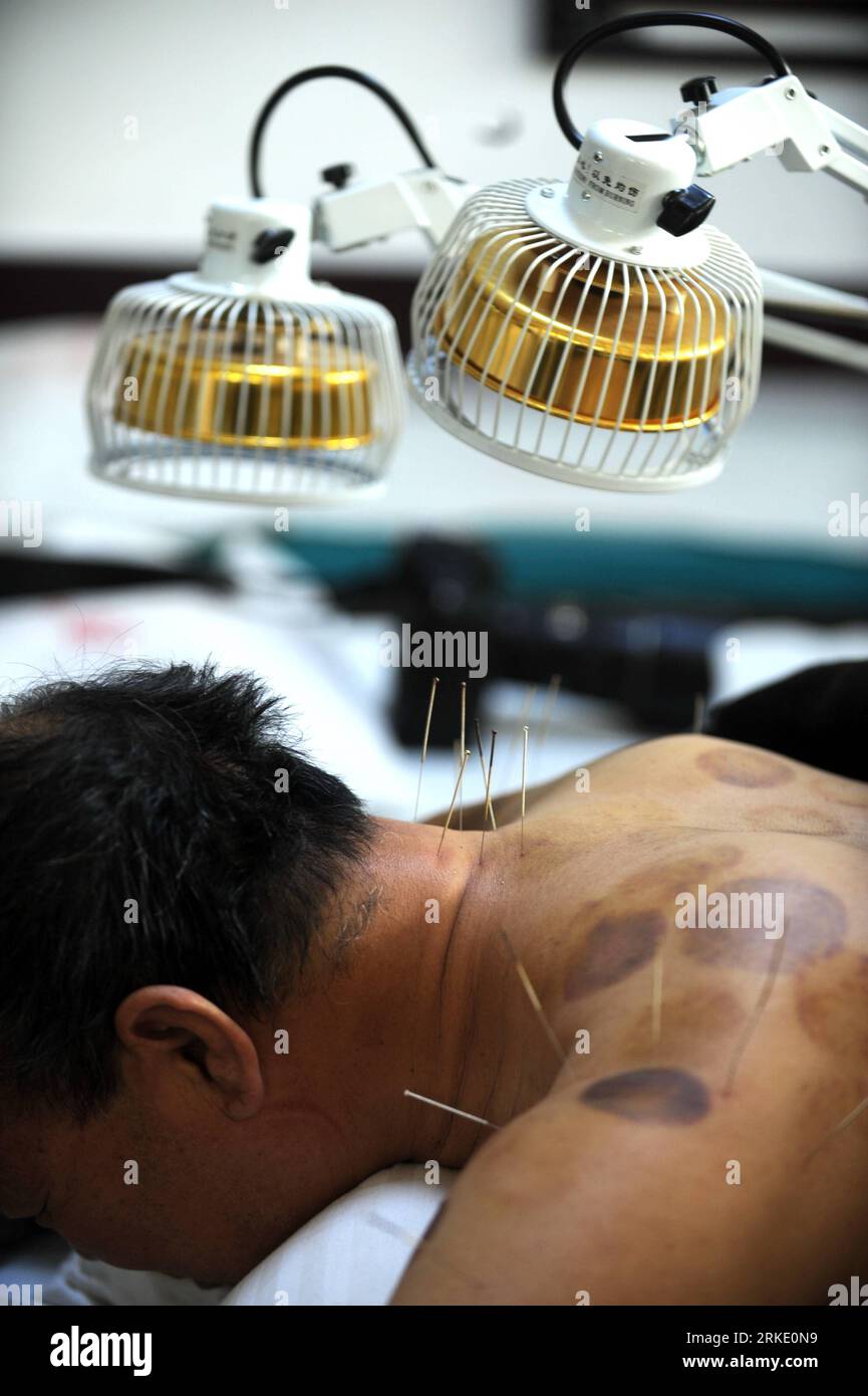 Bildnummer : 55029666 Datum : 15.03.2011 Copyright : imago/Xinhua (110315) -- GANSU, 15 mars 2011 (Xinhua) -- Un patient reçoit un traitement d'acupuncture dans un hôpital municipal du district de Liangzhou dans la ville de Wuwei, province du Gansu, au nord-ouest de la Chine, 14 mars 2011. La thérapie de médecine traditionnelle chinoise est populaire dans le district de Liangzhou avec plus de 1 200 médecins chinois fournissant des services dans les hôpitaux de tous les niveaux ici. Souffrant de maux courants et de maladies fréquentes ont le droit de payer moins si vous choisissez la thérapie de médecine traditionnelle chinoise. Cette politique bienfaitrice Banque D'Images