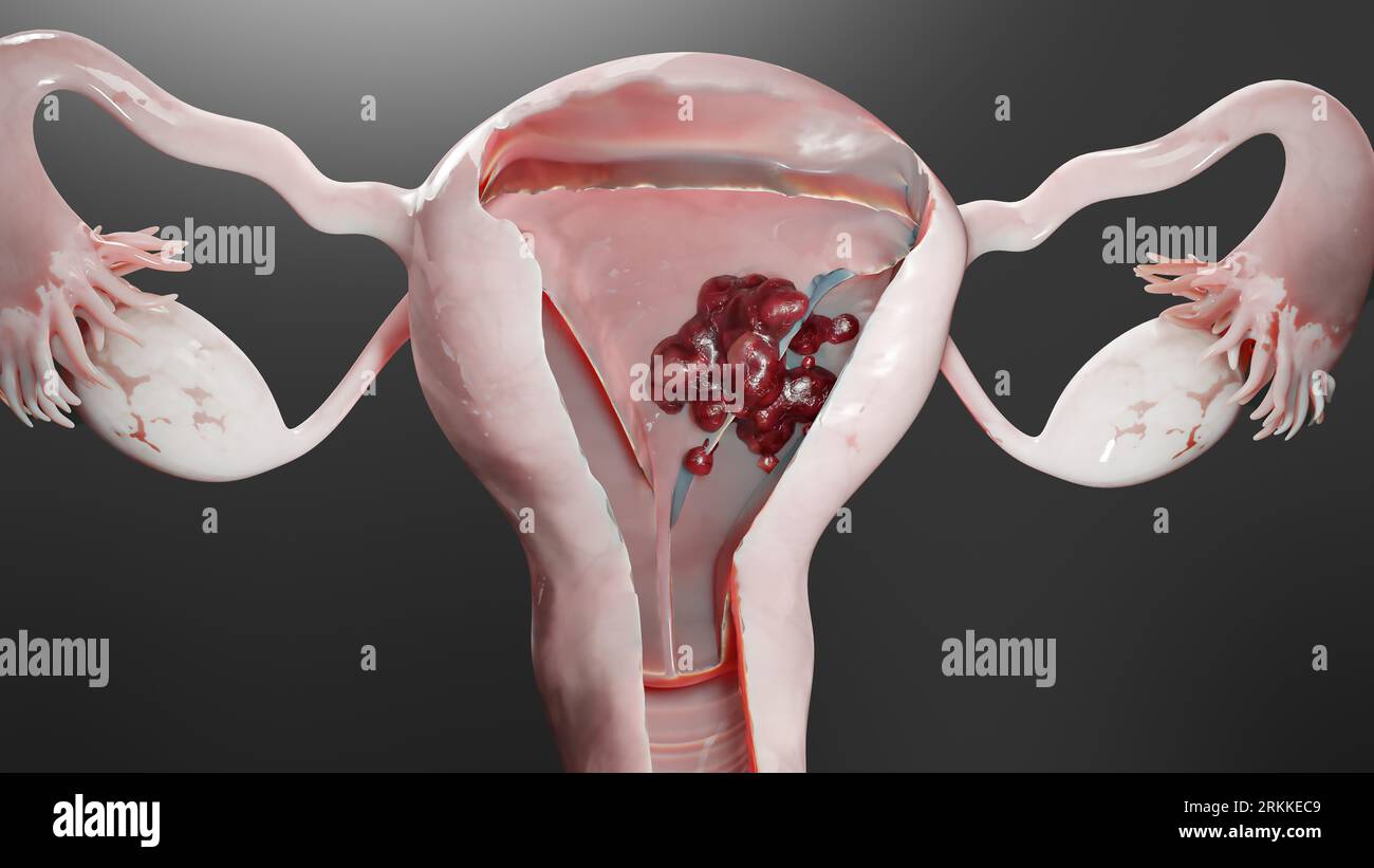 Tumeur maligne de l'utérus, anatomie de l'utérus féminin, système reproductif, cellules cancéreuses, kystes des ovaires, cancer du col de l'utérus, cellules en croissance, maladie gynécologique Banque D'Images
