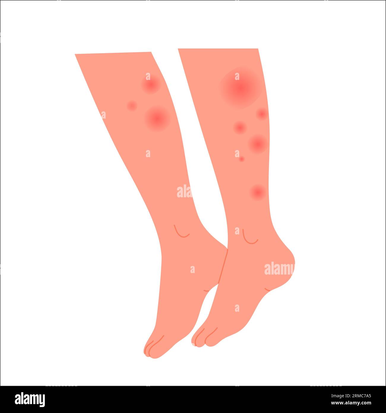 Jambes humaines couvertes d'une éruption rouge. Pieds avec réaction allergique, irritation de la peau illustration vectorielle plate Illustration de Vecteur