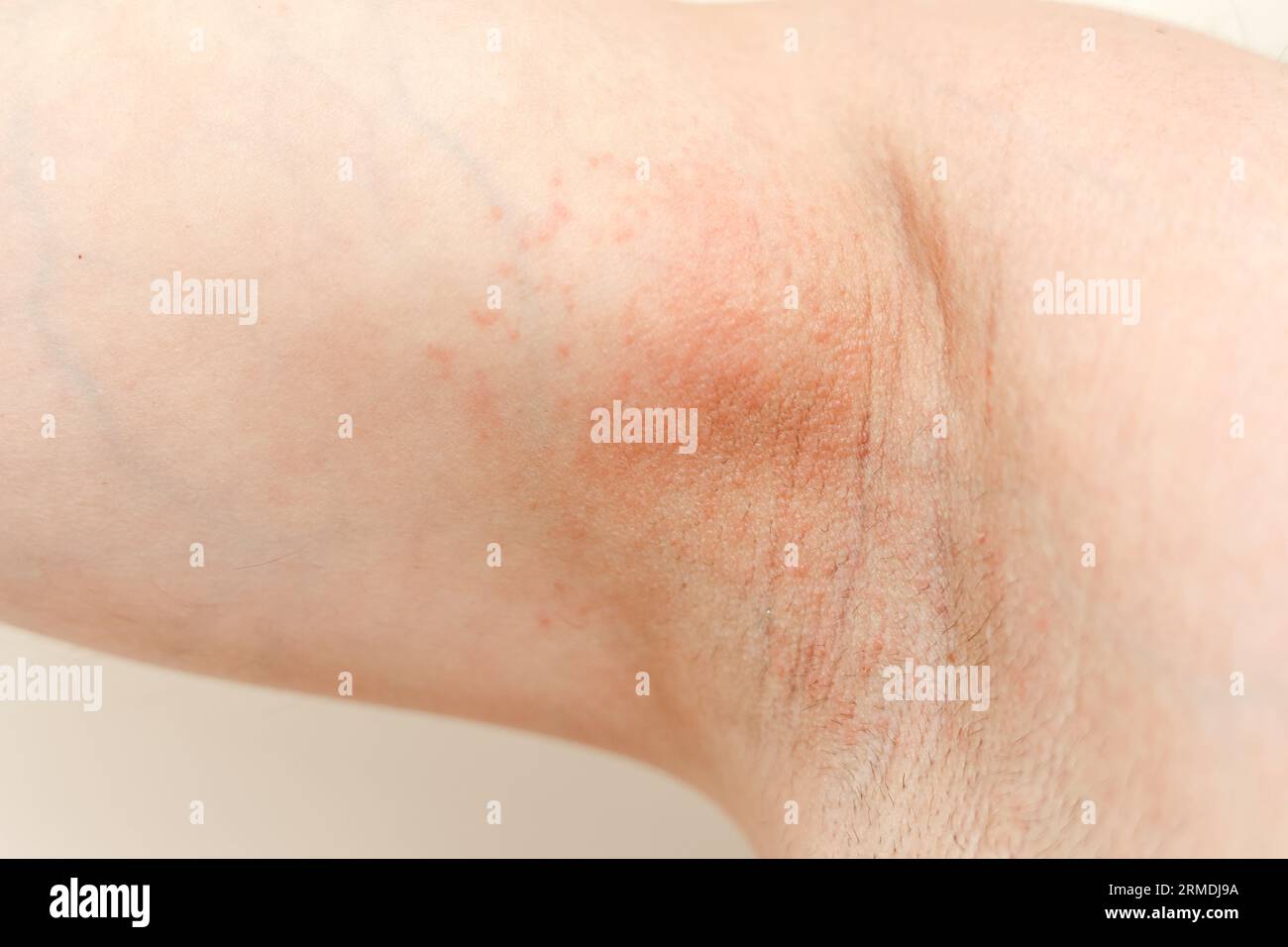 Allergie aux aisselles. Photo recadrée d'irritation, d'inflammation sur la  peau sensible après utilisation d'un rasoir, d'une tondeuse, d'un déodorant  toxique ou d'un antisudorifique. Bras Photo Stock - Alamy