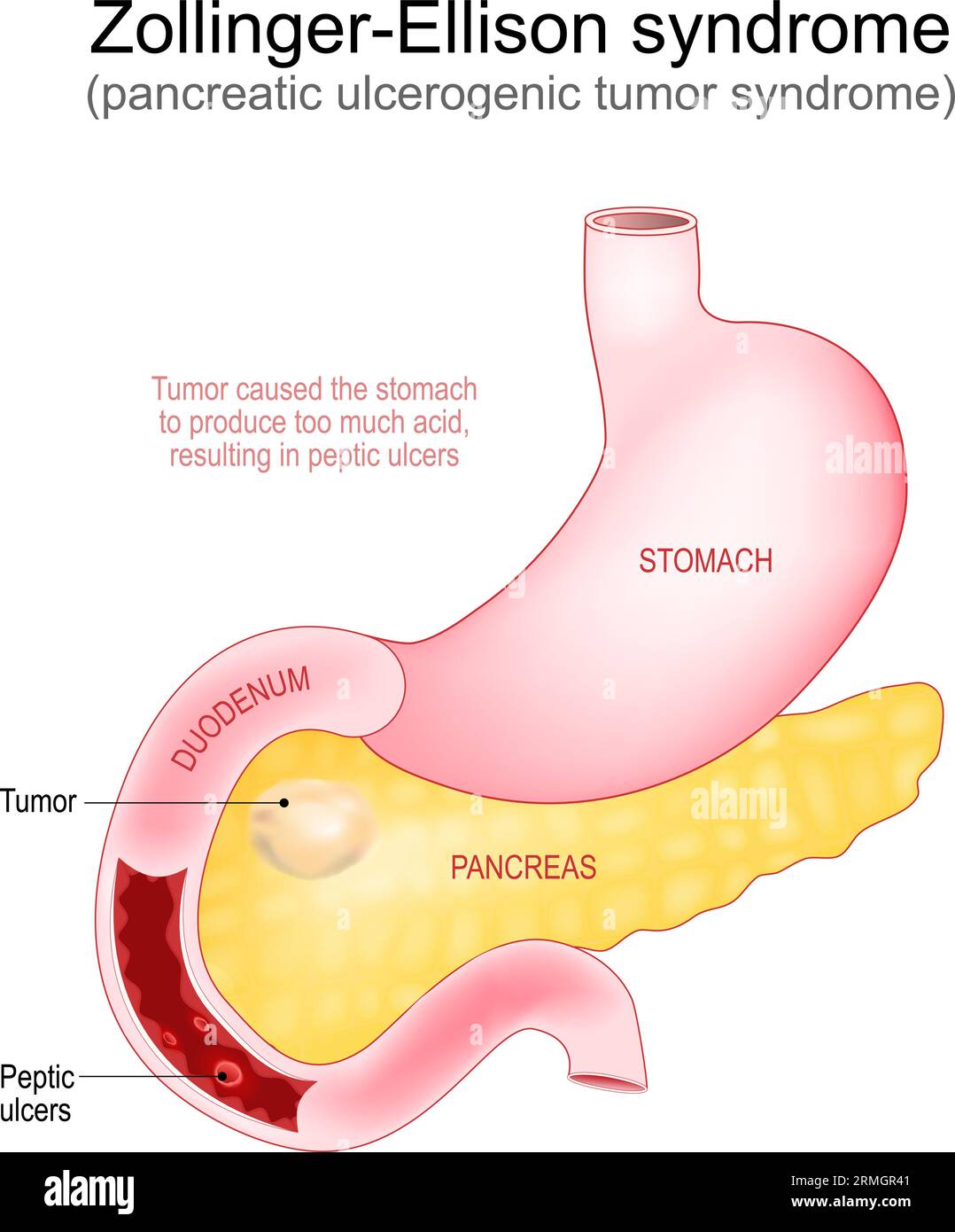 Syndrome de Zollinger-Ellison. Le gastrinome est une tumeur développée dans le pancréas qui a causé des ulcères peptiques dans le duodénum. Partie du système digestif humain. Illustration de Vecteur
