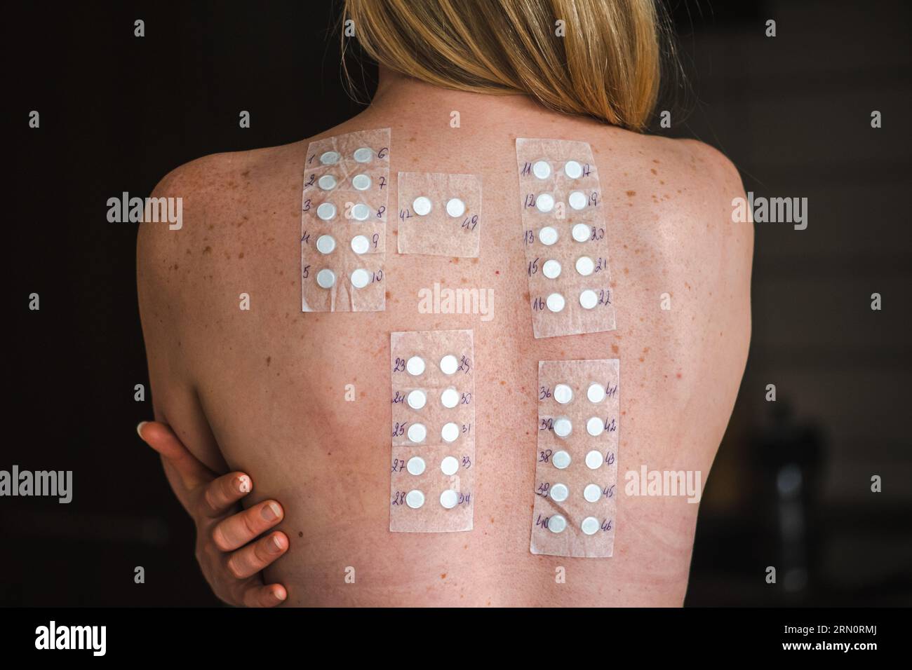Vrai patch test sur l'épaule nue et le dos d'une jeune fille blonde cheveux. Test d'allergie réaction allergique cutanée allergique Banque D'Images