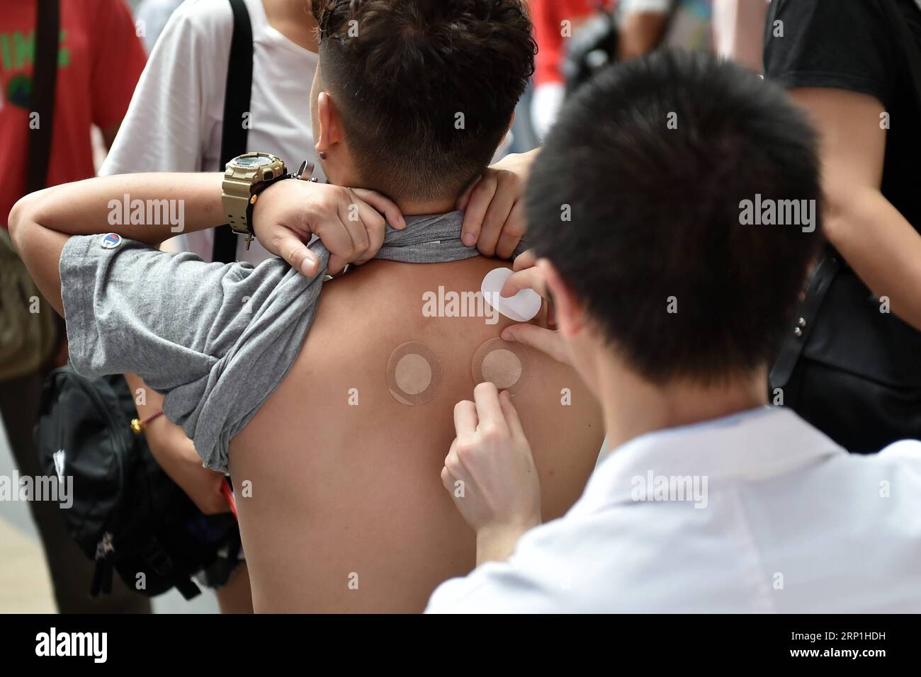 (180707) -- GUANGZHOU, 7 juillet 2018 -- Un médecin colle la pâte de Sanfu sur le dos d'un patient dans un hôpital de Guangzhou, dans la province du Guangdong du sud de la Chine, le 7 juillet 2018. Sanfu Paste est une procédure en médecine traditionnelle chinoise dans laquelle des patchs médicamenteux sont placés sur divers points d'acupuncture sur le corps. Sanfu, la période la plus chaude sur le calendrier chinois, est considéré comme un moment particulièrement approprié pour traiter la maladie.) (ly) CHINA-GUANGDONG-SANFU PATE-TRAITEMENT (CN) LiangxXu PUBLICATIONxNOTxINxCHN Banque D'Images