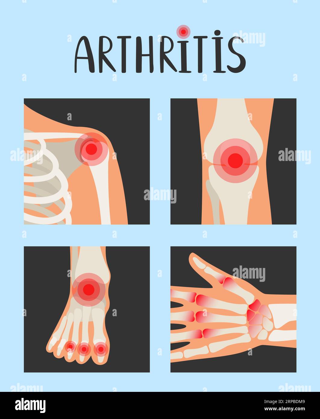 Articulations du squelette humain avec des points rouges douloureux. Illustration vectorielle de la polyarthrite rhumatoïde sur l'inflammation. Arthrites corps et anatomie squelette Illustration de Vecteur