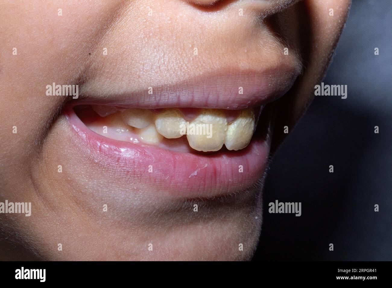 Macro des dents de bébé négligées, avec plaque et tartre et champignon noir. Condition de mauvaise hygiène buccale avec risque d'infection bactérienne. Banque D'Images