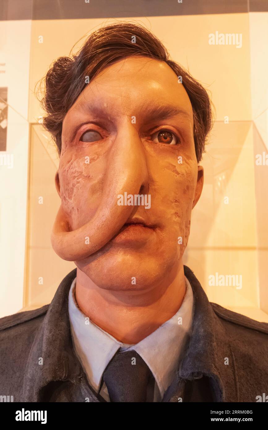 Angleterre, Sussex, West Sussex, East Grinstead, East Grinstead Museum, exposition de travail de cire d'un patient de l'hôpital de la Seconde Guerre mondiale avec greffe de peau pédiculaire tube et reconstruction faciale lancée par le chirurgien Sir Archibald McIndoe Banque D'Images