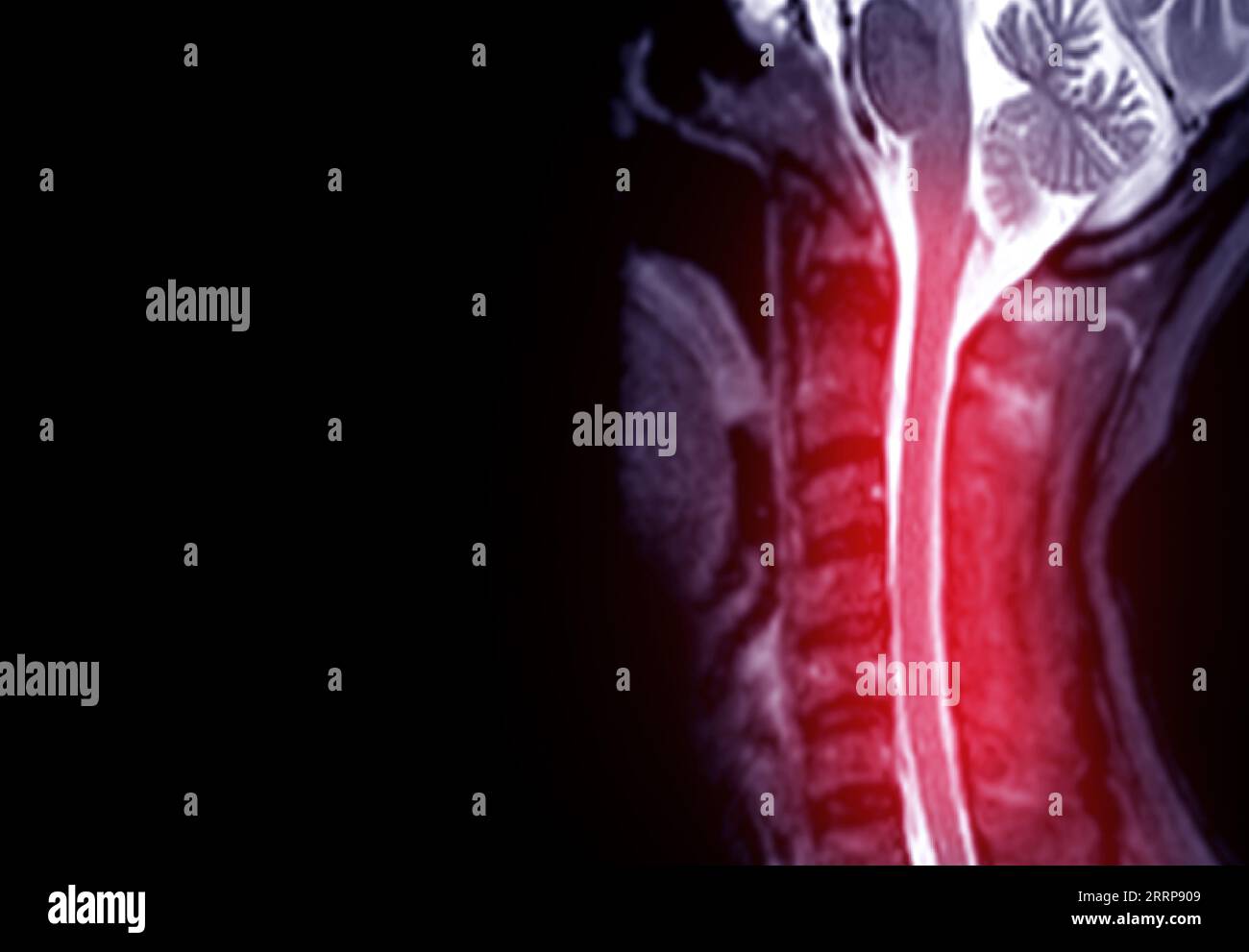 IRM du rachis cervical ou imagerie par résonance magnétique du rachis cervical vue sagittale pour le diagnostic spondylose causant myélopathie cervicale spondylotique et com Banque D'Images