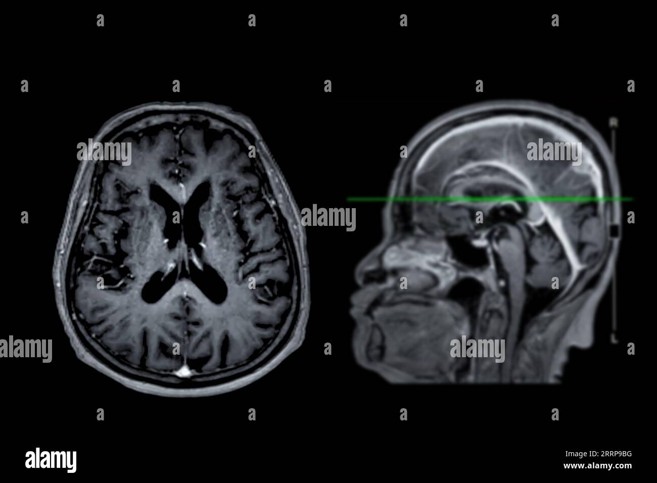 Imagerie cérébrale IRM vue axiale et sagittale avec ligne de référence pour détecter les maladies cérébrales telles que les accidents vasculaires cérébraux, les tumeurs cérébrales et les infections. Banque D'Images