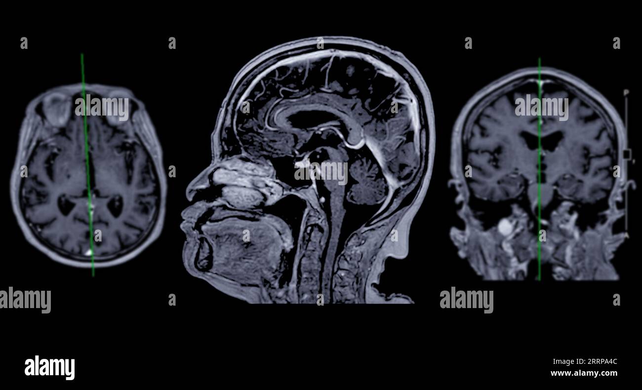 IRM cérébrale vue axiale, coronale et sagittale avec ligne de référence pour détecter les maladies cérébrales telles que les accidents vasculaires cérébraux, les tumeurs cérébrales et les infections. Banque D'Images