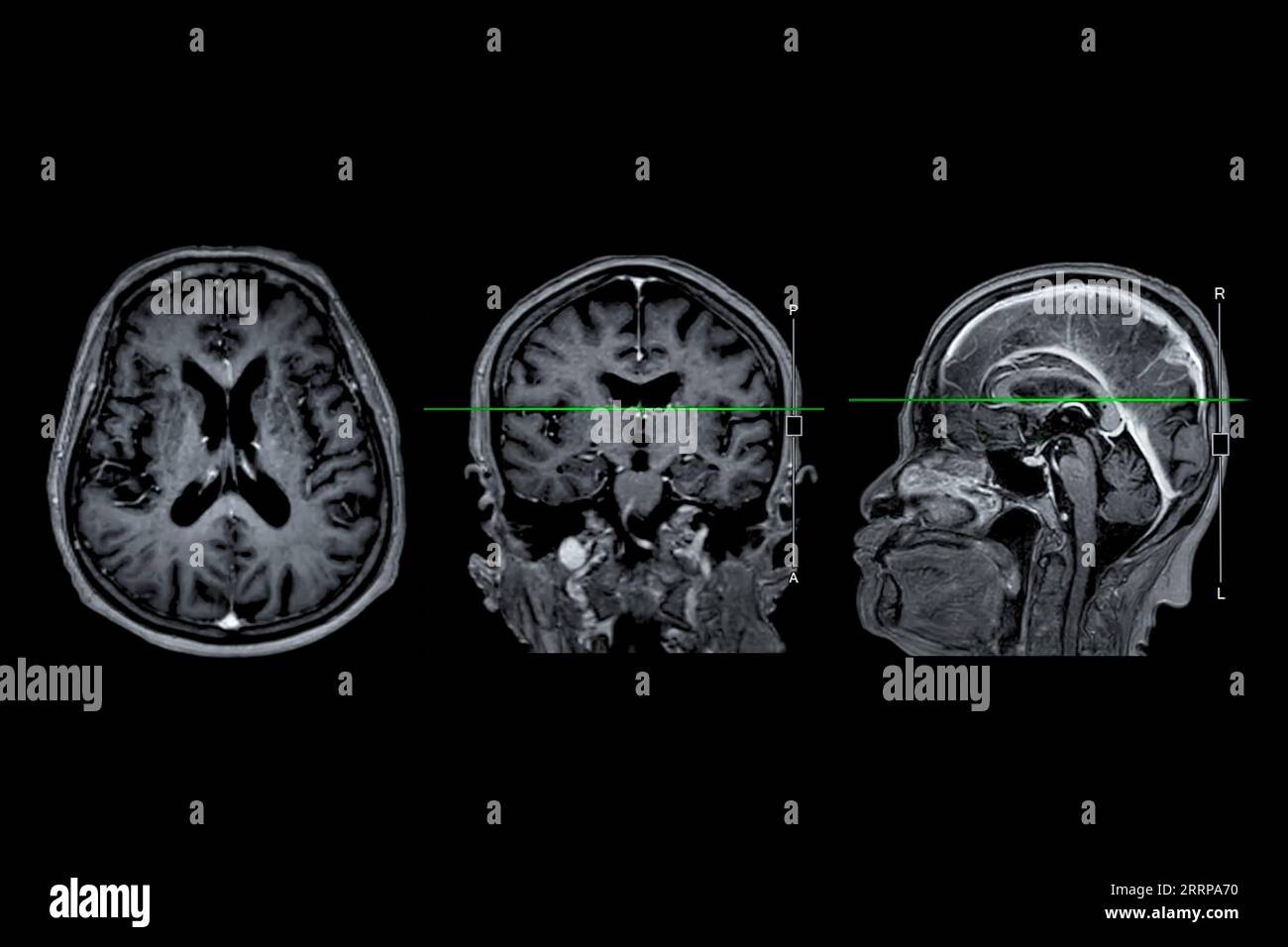 IRM cérébrale vue axiale, coronale et sagittale avec ligne de référence pour détecter les maladies cérébrales telles que les accidents vasculaires cérébraux, les tumeurs cérébrales et les infections. Banque D'Images