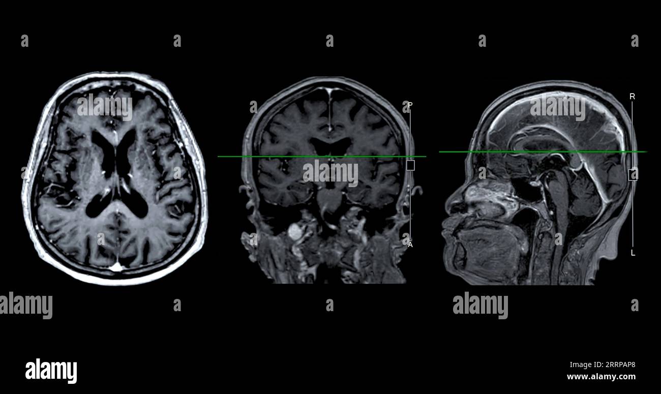IRM cérébrale vue axiale, coronale et sagittale avec ligne de référence pour détecter les maladies cérébrales telles que les accidents vasculaires cérébraux, les tumeurs cérébrales et les infections. Banque D'Images