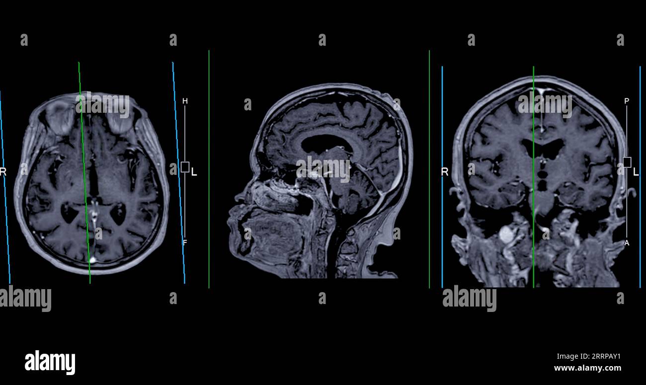 IRM cérébrale vue axiale, coronale et sagittale avec ligne de référence pour détecter les maladies cérébrales telles que les accidents vasculaires cérébraux, les tumeurs cérébrales et les infections. Banque D'Images